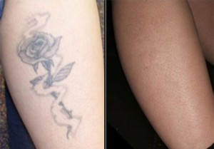 ... tattoo is off in the Boston area for a reasonable tattoo removal cost