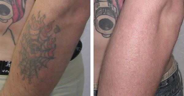 Tattoo Off &amp; Tattoo Removal Cost in Boston | Fresh Start Skincare ...